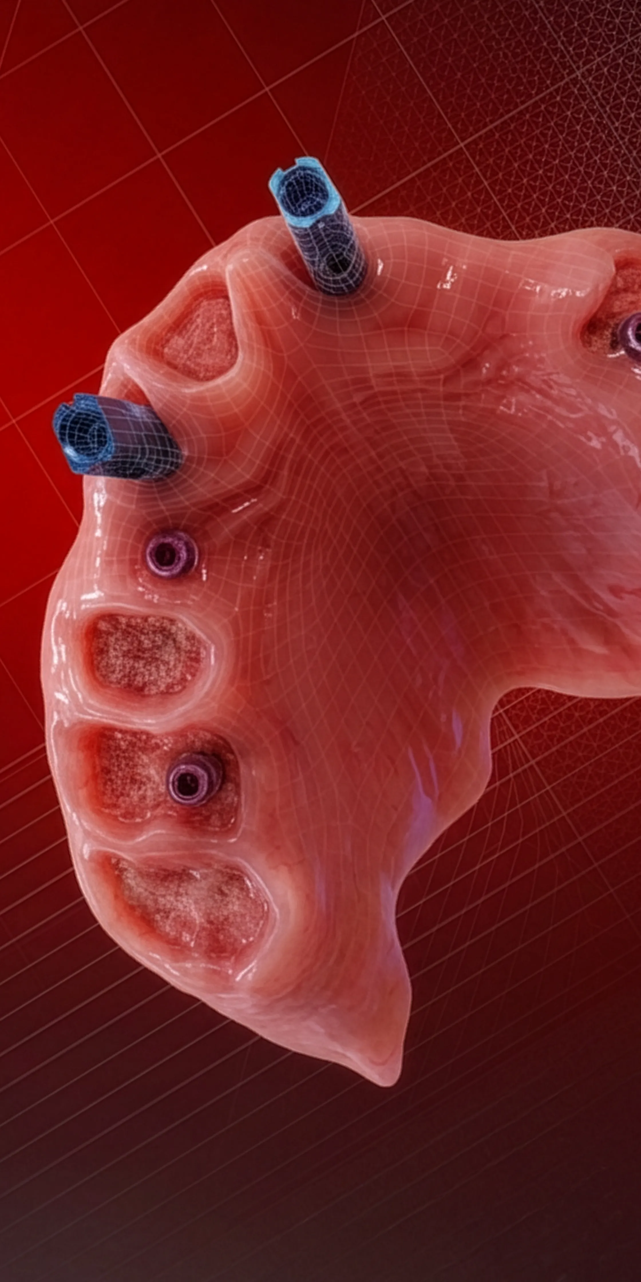 GUIDED STACKABLE FULL ARCH LIVE SURGERY