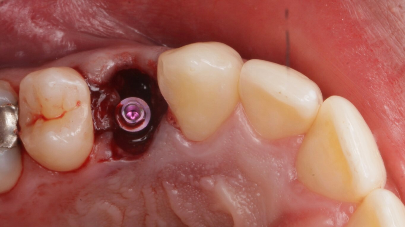 After - Full Arch Surgery with Dr. Khartic Patel