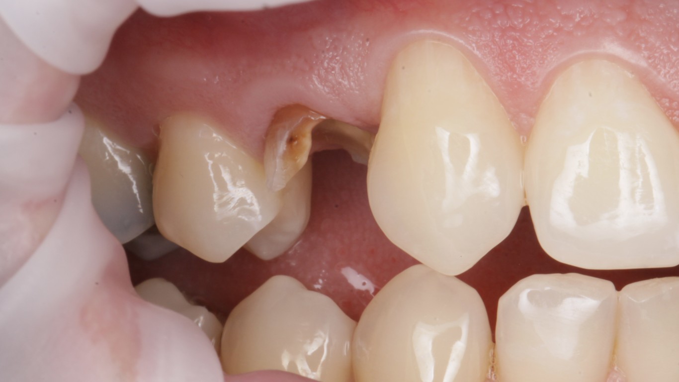 Before - Full Arch Surgery with Dr. Khartic Patel