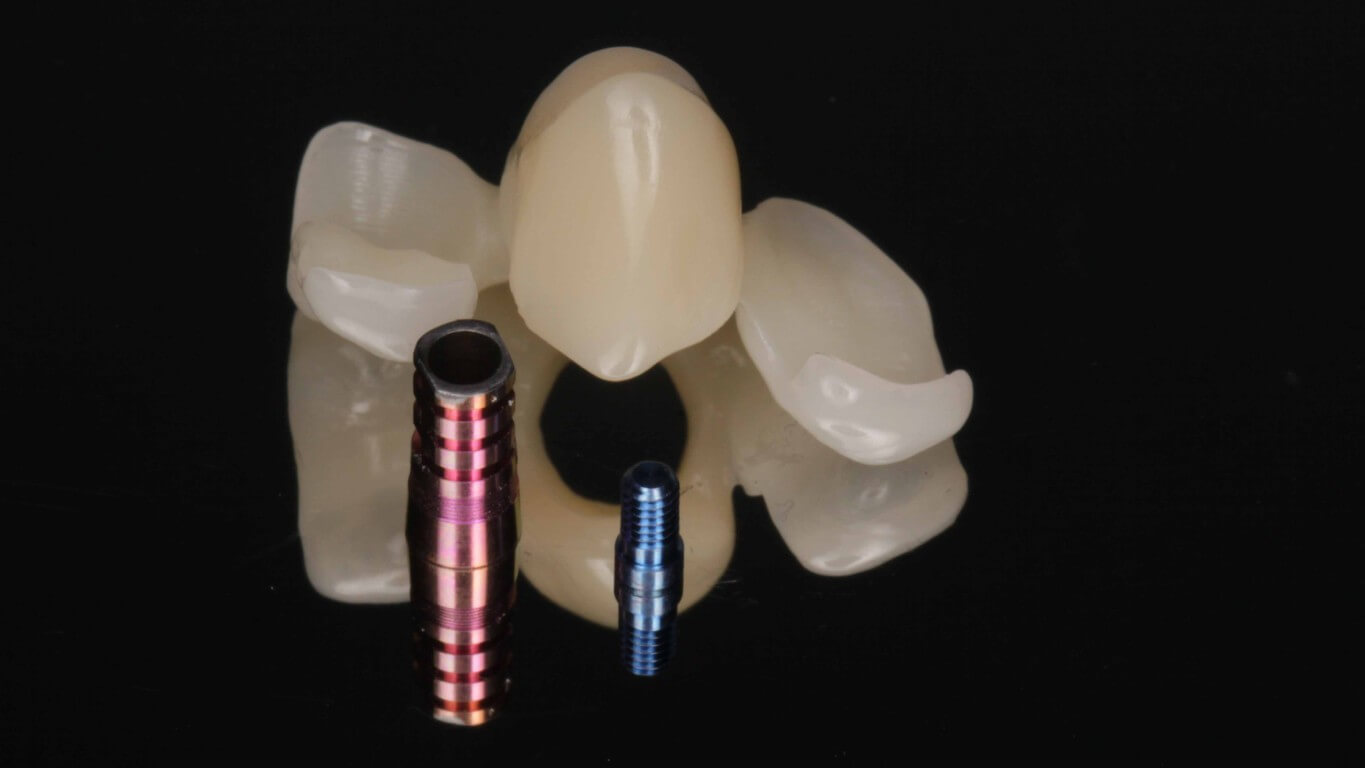 Additional media for Full Arch Surgery with Dr. Khartic Patel