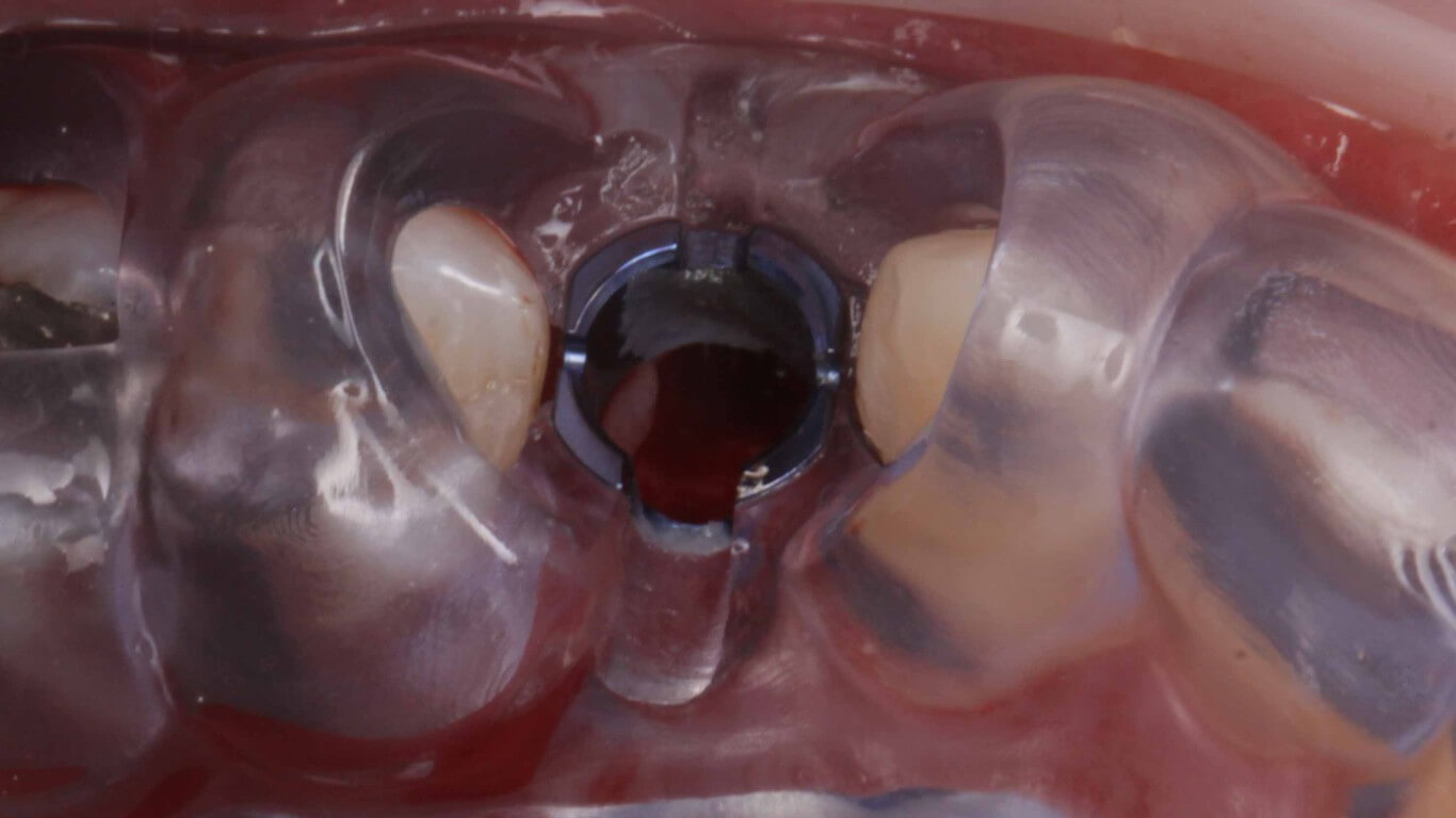 Gallery image for Full Arch Surgery with Dr. Khartic Patel