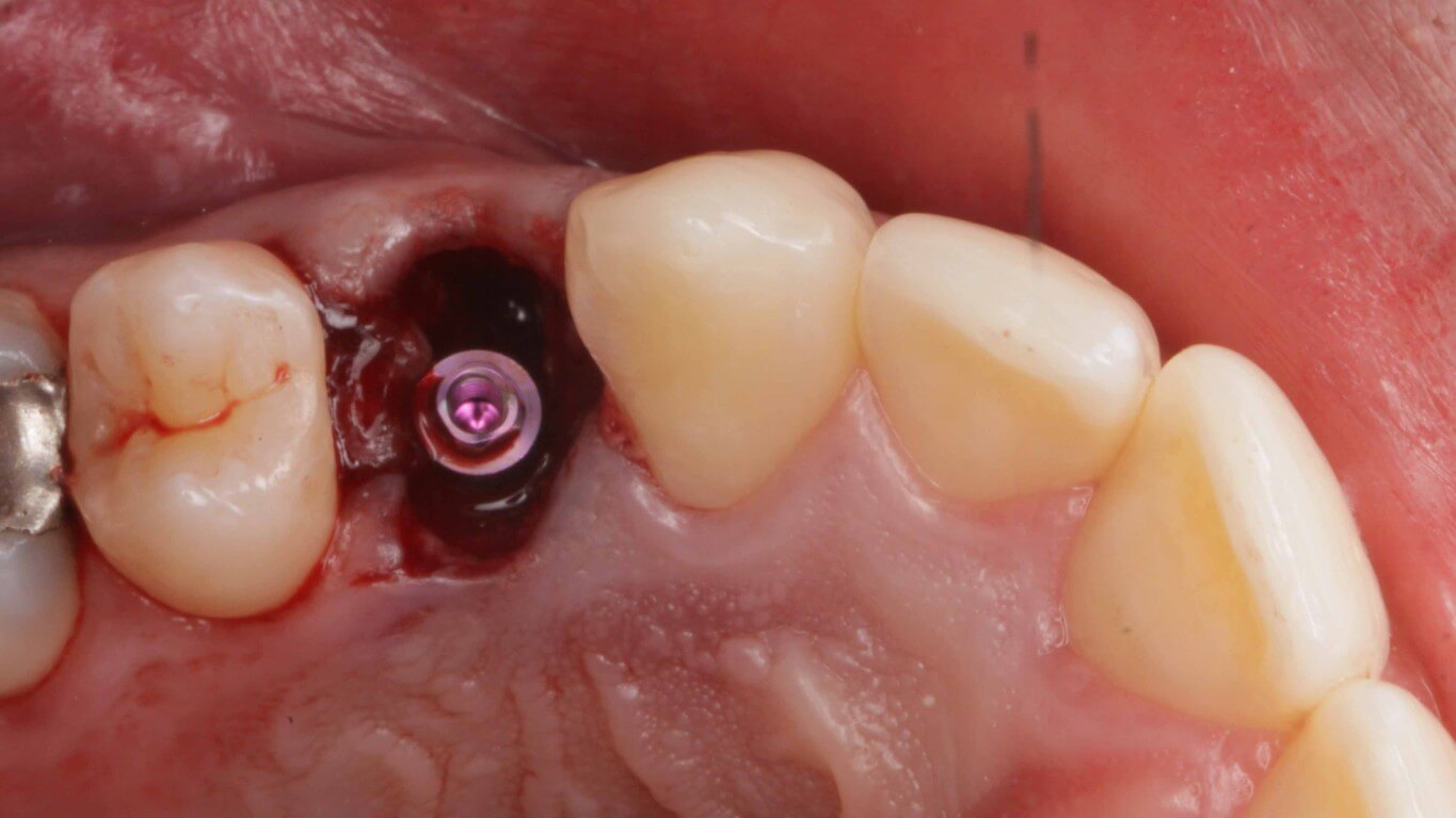 Gallery image for Full Arch Surgery with Dr. Khartic Patel