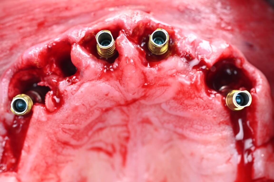 After - Full Arch Surgery with Dr. Shubhan Mittal