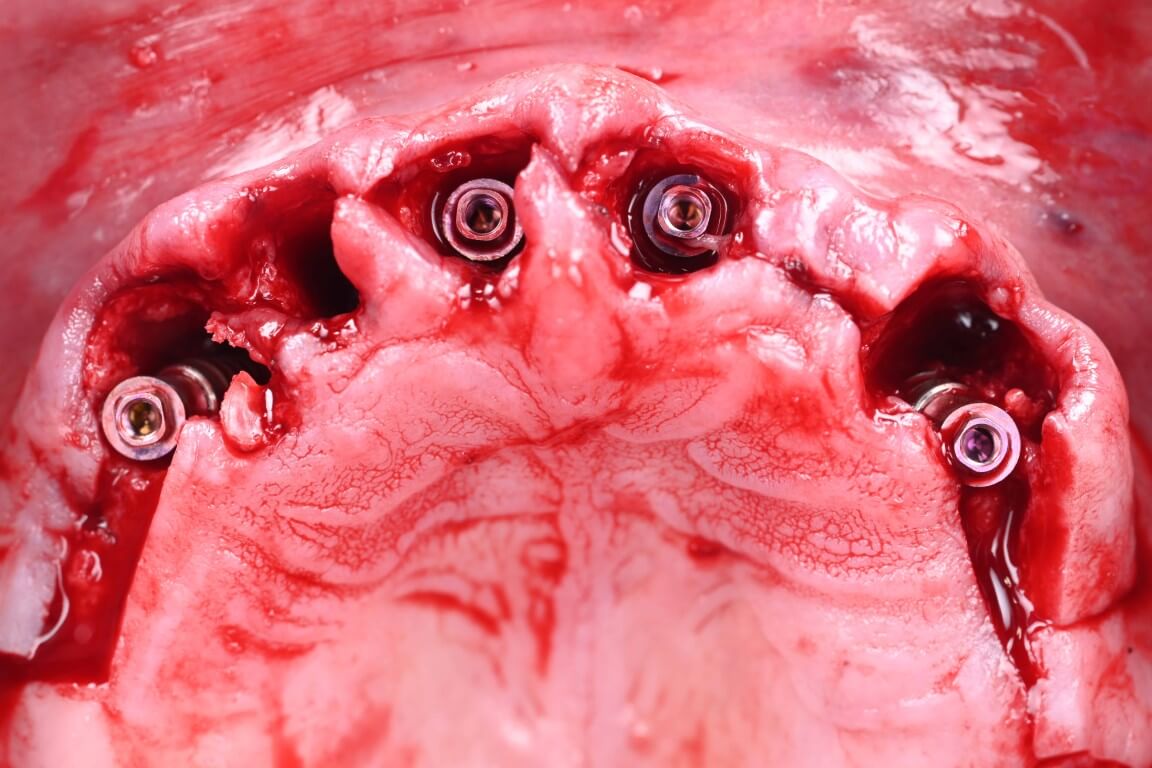 Before - Full Arch Surgery with Dr. Shubhan Mittal