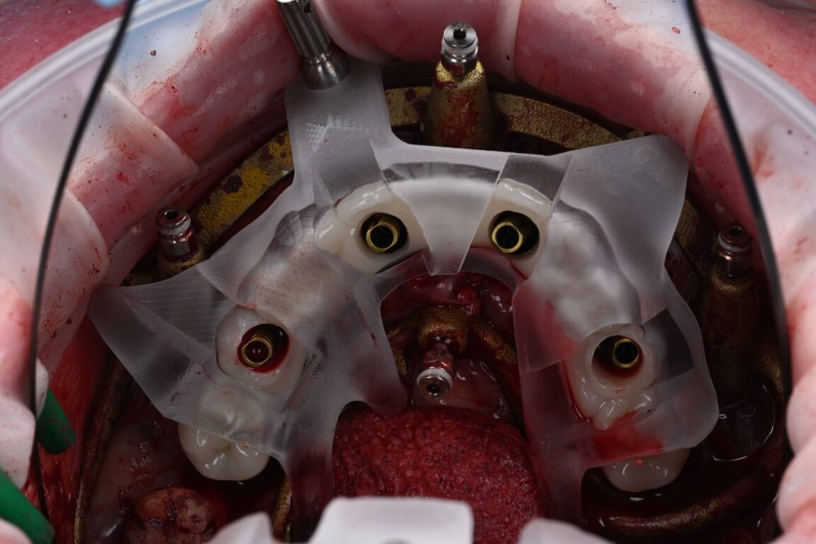 Additional media for Full Arch Surgery with Dr. Shubhan Mittal