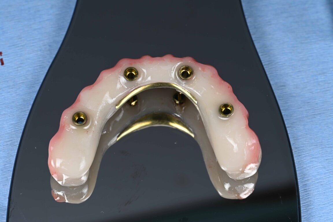 Gallery image for Full Arch Surgery with Dr. Shubhan Mittal