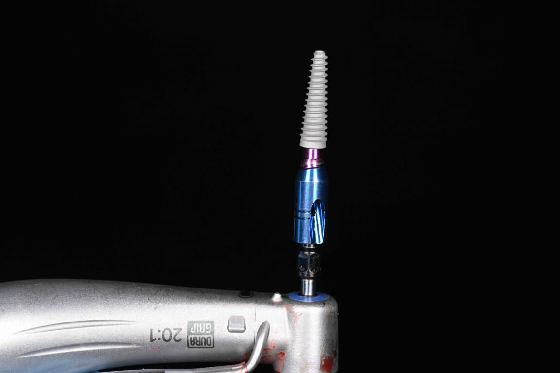 Gallery image for Full Arch Surgery with Dr. Shubhan Mittal