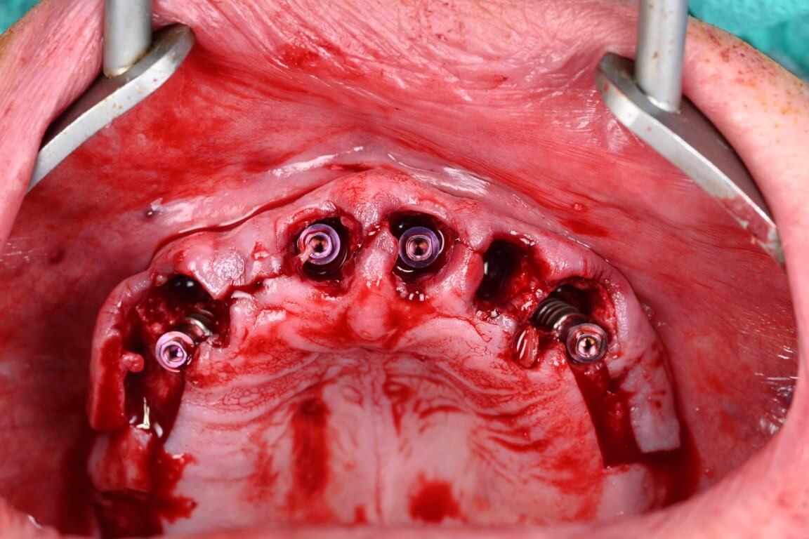 Gallery image for Full Arch Surgery with Dr. Shubhan Mittal