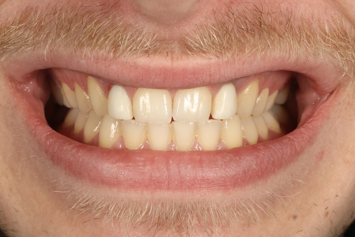 After - Profilo Guided Surgery with Dr. Simon Chard