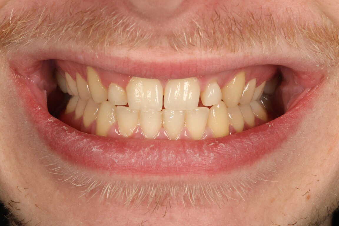 Before - Profilo Guided Surgery with Dr. Simon Chard