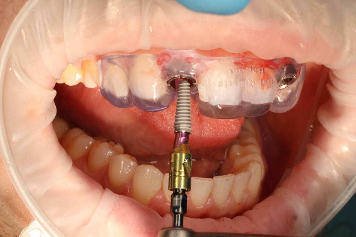 Gallery image for Profilo Guided Surgery with Dr. Simon Chard