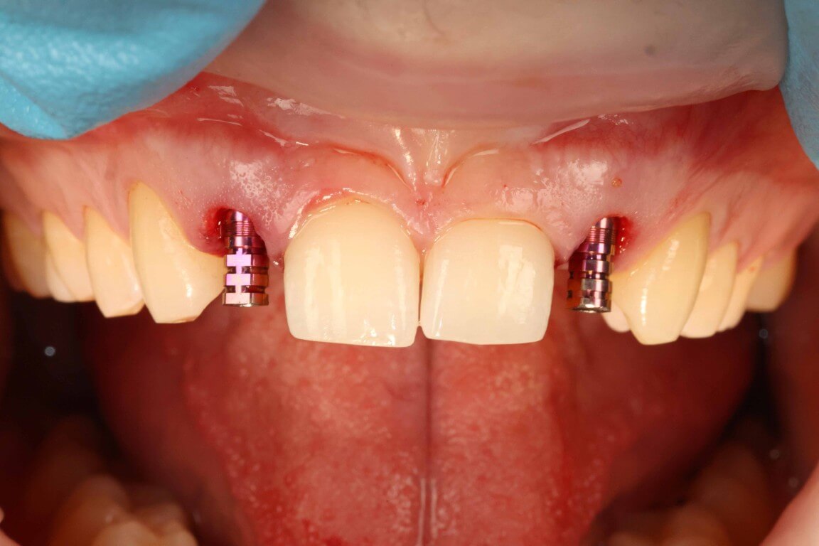 Gallery image for Profilo Guided Surgery with Dr. Simon Chard